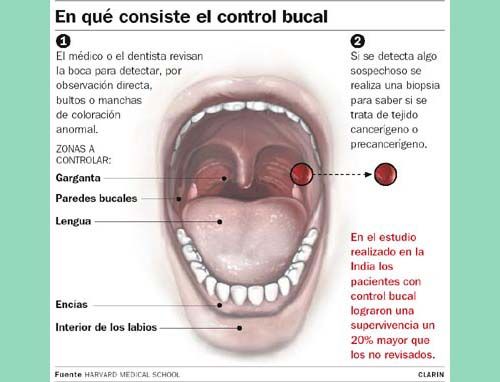 cancer bucal